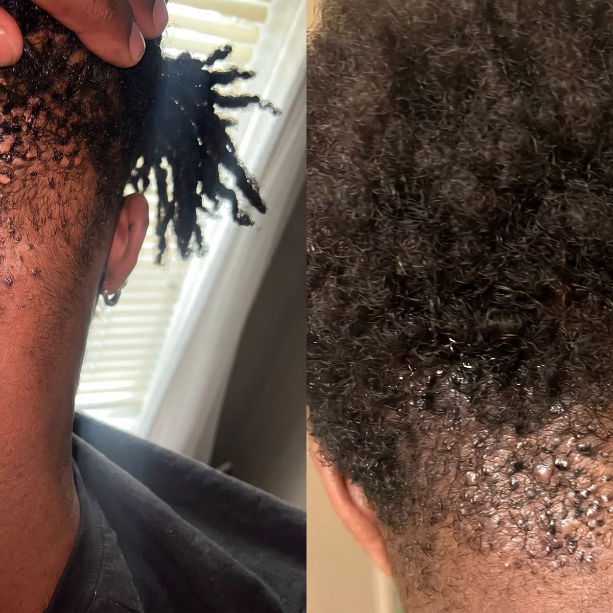 Ingrown Hair Treatment Roll-On - Smooth, Clear Skin Solution upsell